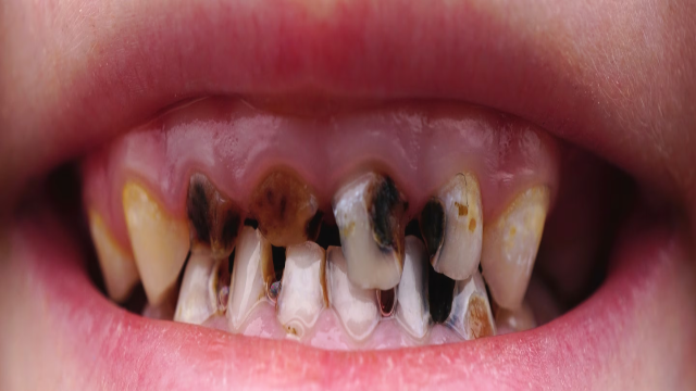 6 Jenis Permen yang Berfungsi Menghilangkan Karies Gigi